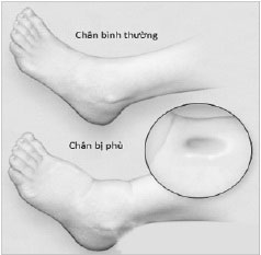 Swelling due to heart failure is soft and pitting.