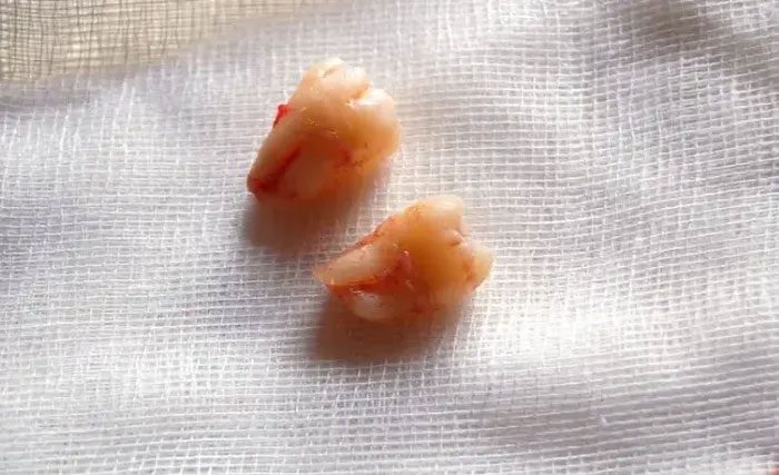 Keeping wisdom teeth trapped beneath the gums increases the risk of painful and deadly infections.