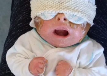 rare disease causes girl in slovakia to have skin like a turtle 118764