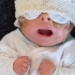 rare disease causes girl in slovakia to have skin like a turtle 118764