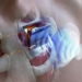 research new help battery implant heartbeat without surgery 120175