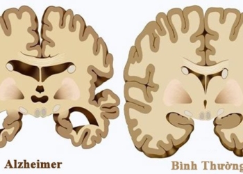 research shows that people may develop alzheimers disease due to nose picking 124026