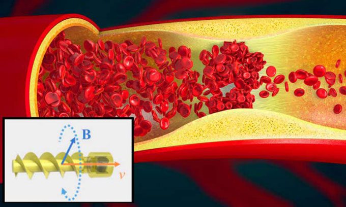 Illustration of a blood clot and a tiny spiral robot.