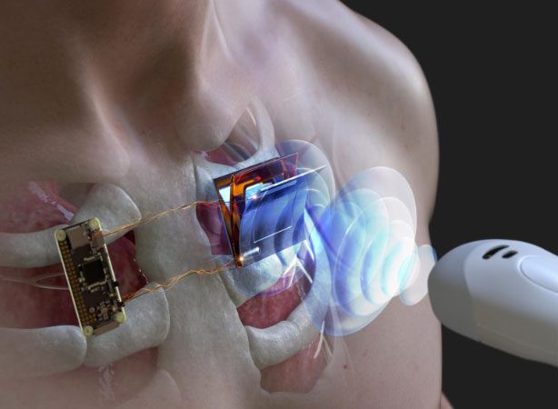 Illustration of charging a pacemaker using acoustic waves