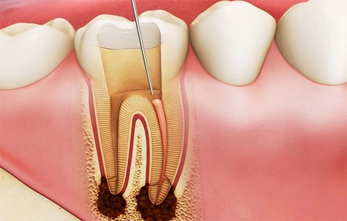 If gingivitis is not treated properly, it can lead to complications such as cavities and tooth loss.