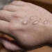 singapore confirms first case of monsoon fever 121292