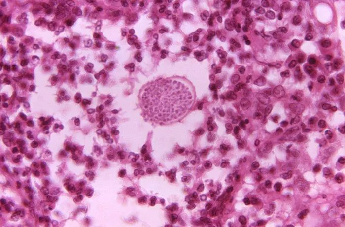 This tissue sample is from a patient with Valley Fever.