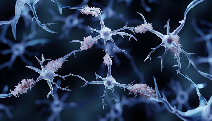 Alzheimer's disease is the most common cause of dementia.