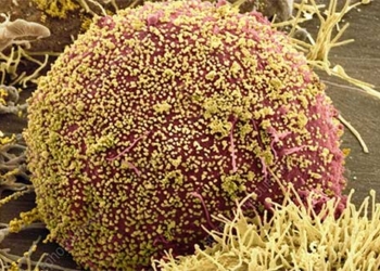 the first woman in the world to be cured of hiv thanks to stem cell therapy 118846