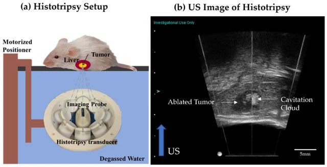 The focused ultrasound device for cancer treatment they are developing.
