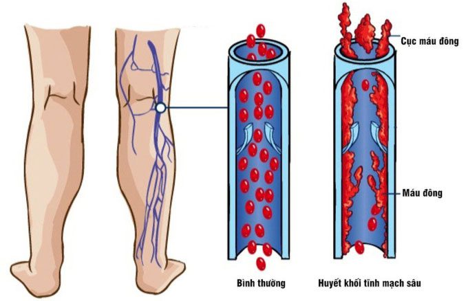 Simulation of venous thrombosis in the leg due to a blood clot.