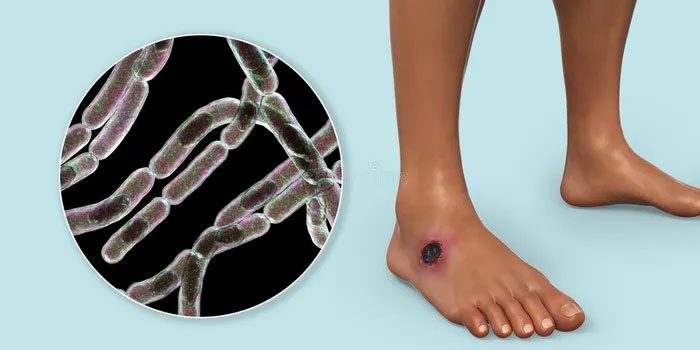 Common characteristic of anthrax is black skin lesions.