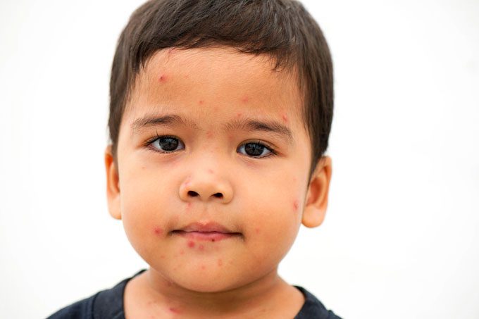 Children infected with tomato flu often present with rashes similar to hand-foot-and-mouth disease.