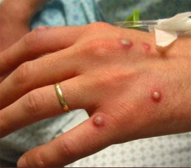 Symptoms of monkeypox infection