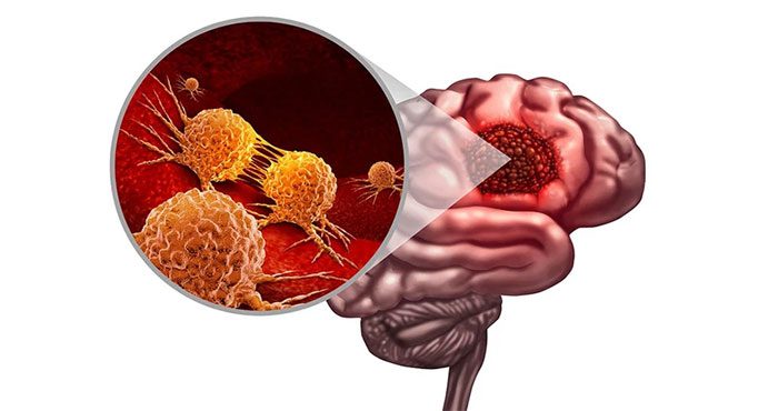 Illustration of Glioblastoma.