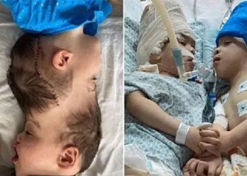 using virtual reality surgeons in uk and brazil successfully separate conjoined twins 122108