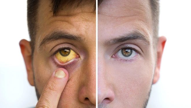 Jaundice or Yellowing of the Eyes