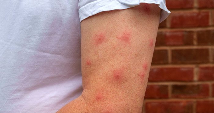 There are many reasons why one person gets bitten by mosquitoes more than others