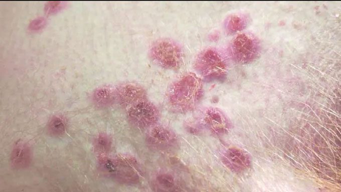 Skin lesions caused by monkeypox.