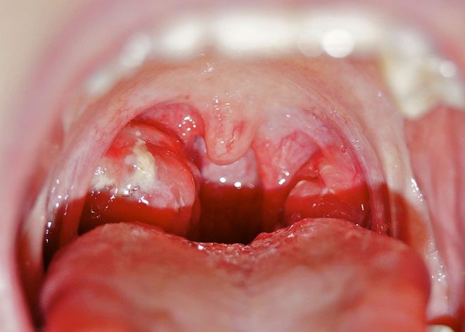 Acute throat infections can lead to complications such as acute glomerulonephritis, rheumatic fever, and acute arthritis.