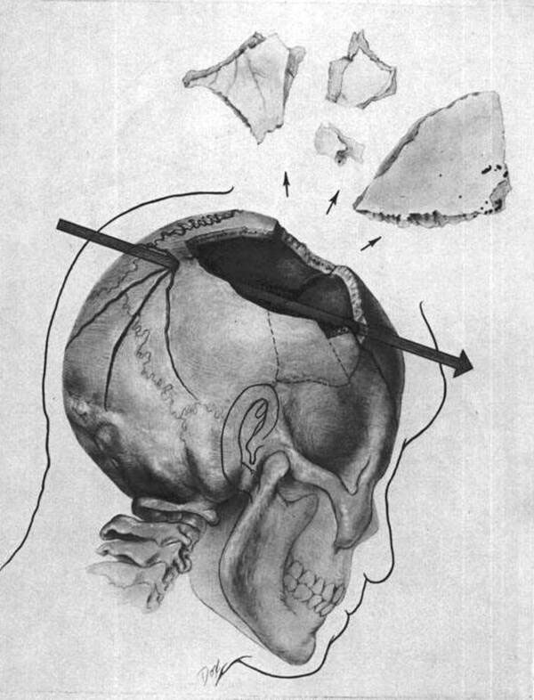 Illustration showing one of the bullets passing through JFK's brain.