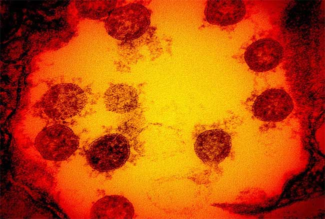 Image of SARS-CoV-2 virus under a microscope.
