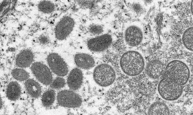 Monkeypox virus under a microscope.