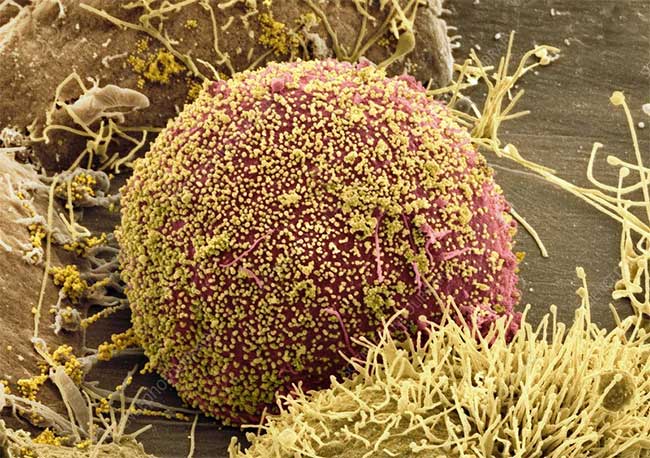 HIV virus (yellow) surrounding patient cells.