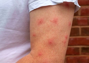 why do some people get bitten by mosquitoes more than others 121229