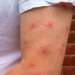 why do some people get bitten by mosquitoes more than others 121229