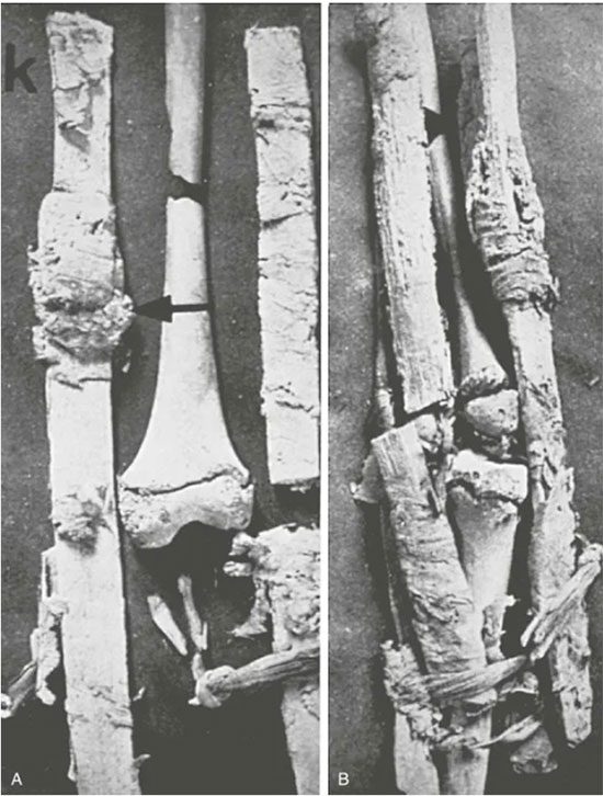 A and B, Juvenile femur fracture specimens dating around 300 BC