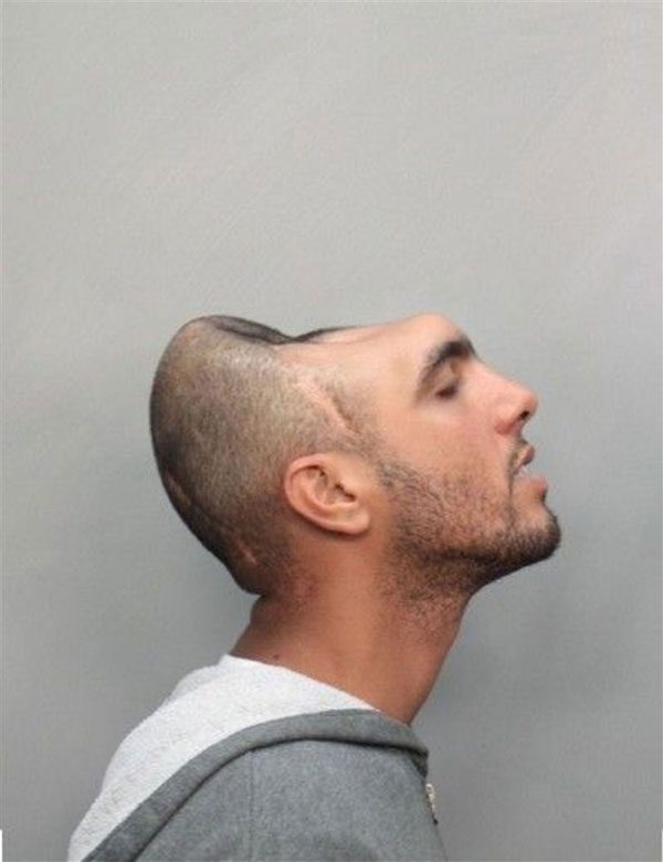 After the traffic accident, a significant part of Carlos's brain had to be removed.