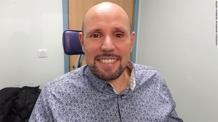 It is hard to recognize that his left eye is a prosthetic
