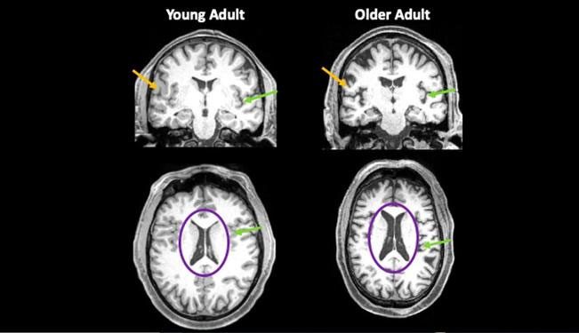 Covid-19 patients experience loss/reduction in brain volume even when their illness does not require hospitalization.
