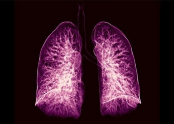 artificial intelligence can diagnose lung cancer early by one year 115853