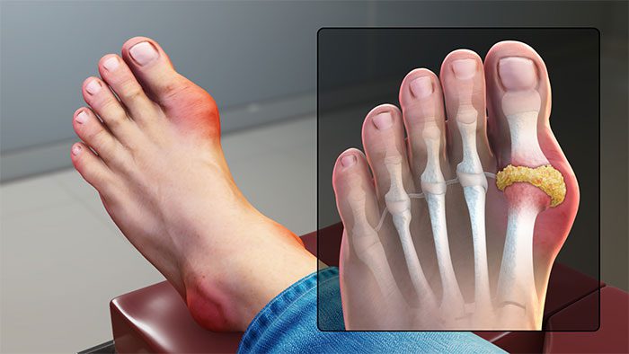 Gout is another type of arthritis that causes severe pain