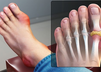 difference between gout and rheumatoid arthritis 117396