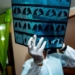 discovery of gene increasing twice the risk of lung failure and death from covid 19 116978