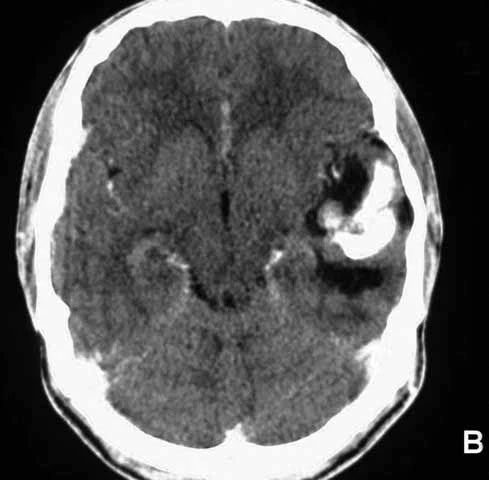 CT scan helps locate a tumor in the brain.