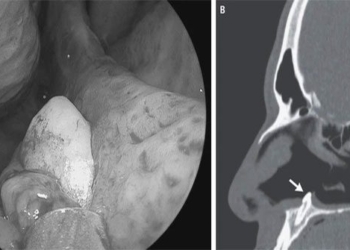 many years later man goes to examine strange object growing in nose 117537