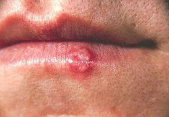 Cold sores, most patients infected with HSV-1 may not experience symptoms.