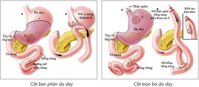 Stomach removal surgery.