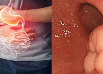 the illness that forced singer minh quan to remove 80 of his dangerous intestines what happened 116681