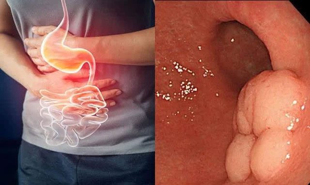 Stomach ulcers can start with dull pain before or after meals.